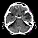 Brain contusion: CT - Computed tomography